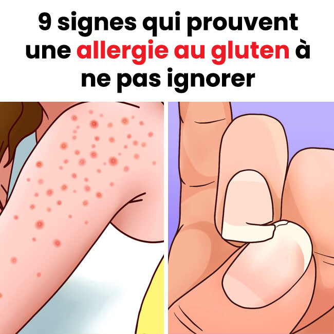 9 signes d'une allergie au gluten