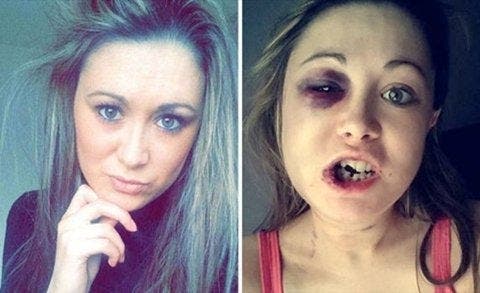 Cette femme a été battu par son petit ami et publie des photos pour dénoncer la violence contre les femmes