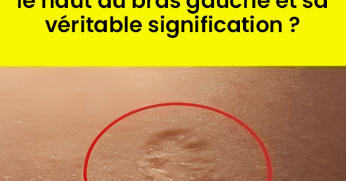 Connaissez-vous la vérité derrière la petite cicatrice sur le haut du bras gauche ?