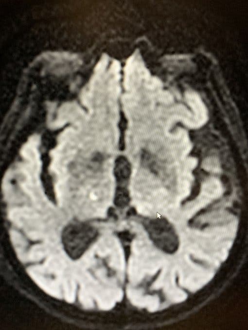 Des médecins ont fait disparaître les tremblements chez les malades de Parkinson