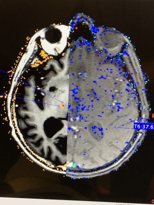 Des médecins ont fait disparaître les tremblements chez les malades de Parkinson