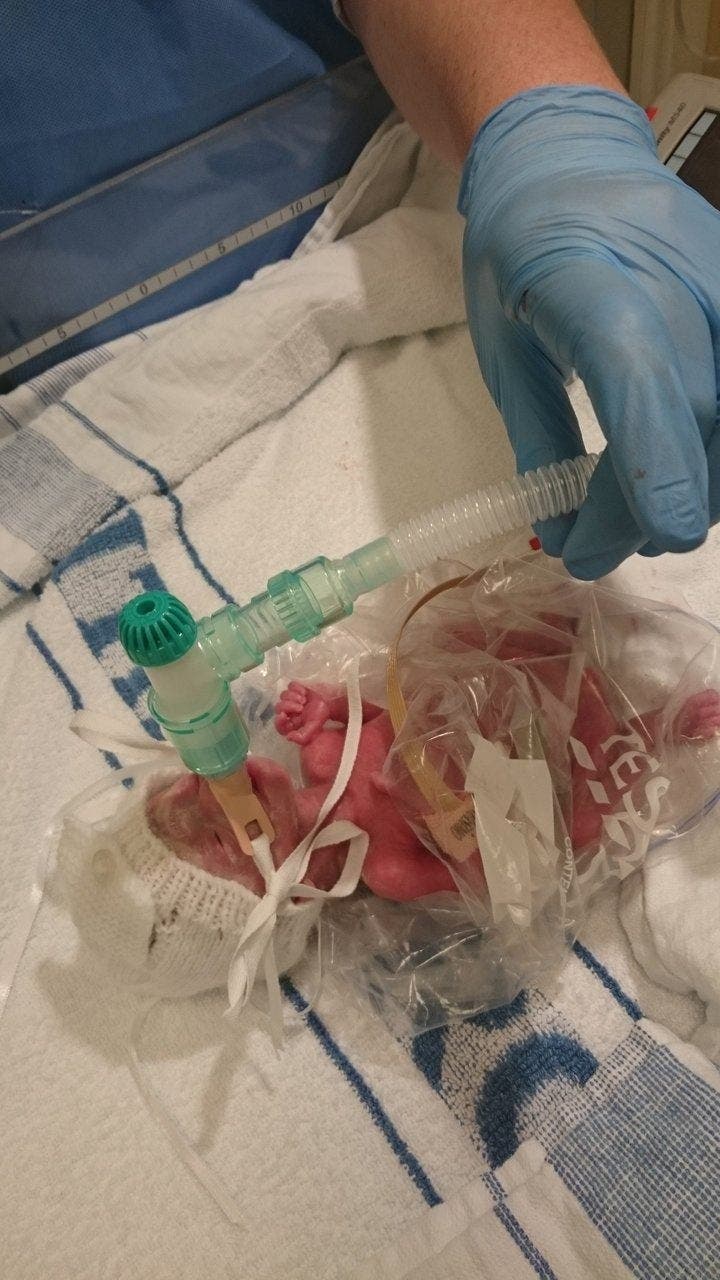 Les médecins ne pensent pas que ce bébé prématuré va survivre alors ils le place dans un sac à sandwich