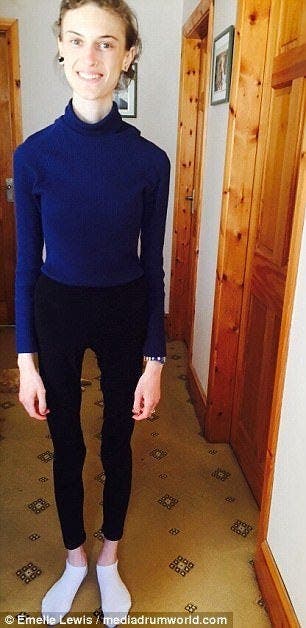 Une jeune fille anorexique montre des photos avant et après sa guérison et elle est devenue très jolie