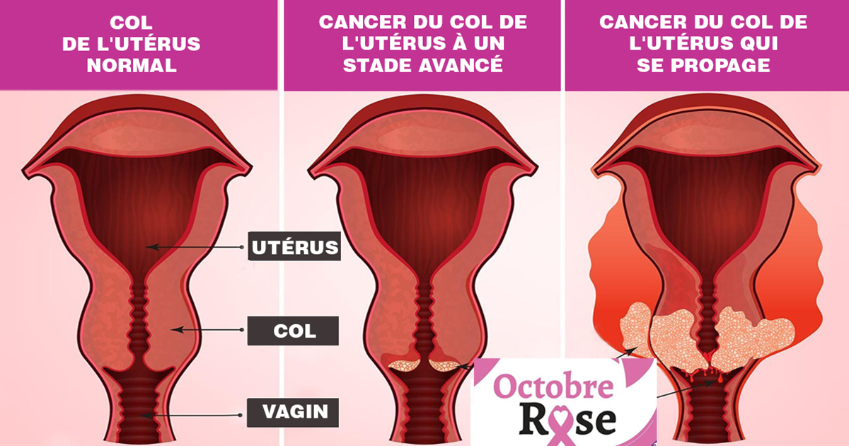 cancer de luterus