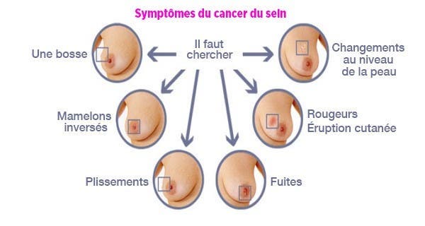 comment-detecter-le-cancer-du-sein1