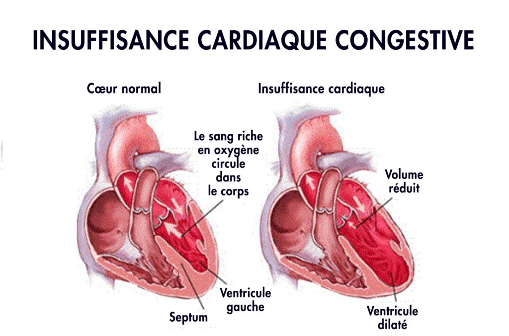 insuffisance cardiaque