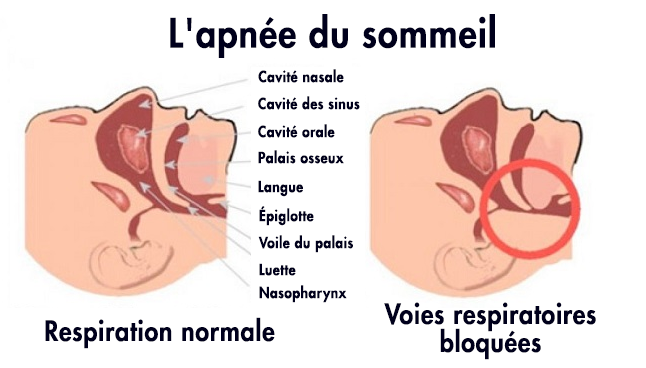 apnée sommeil