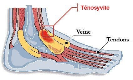 l’inflammation des pieds et des mains que vous devez connaitre