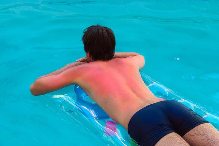 S'exposer au soleil sans protection peut provoquer une brûlure au premier degré. source : spm