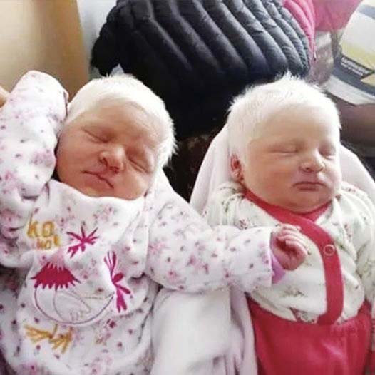 Une maman donne naissance à des jumeaux albinos rares aux cheveux blancs comme neige